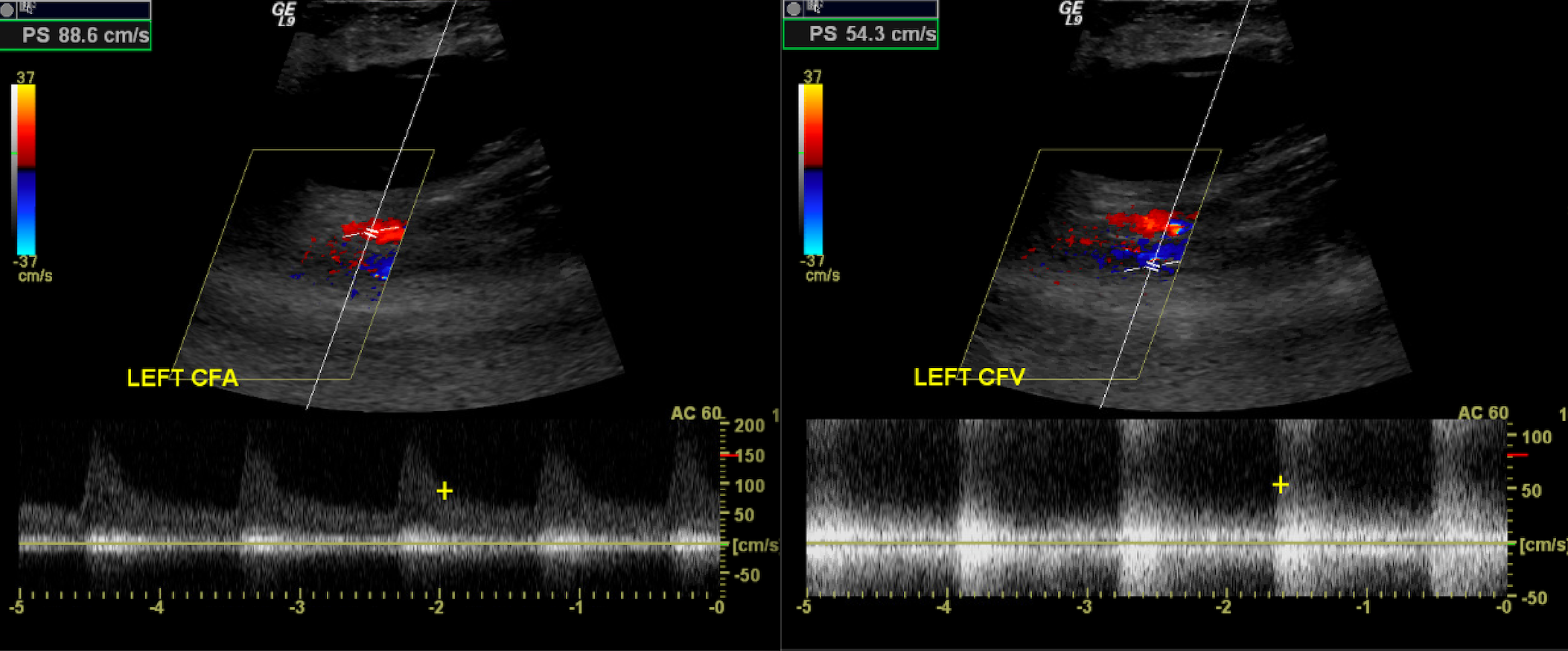 <p>Arteriovenous Fistula