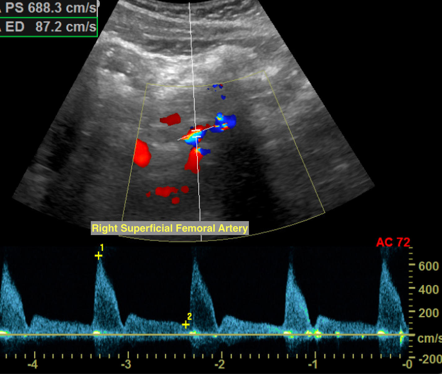 <p>Hemodynamically Significant Stenosis With Turbulent Color Flow and Spectral Broadening.</p>