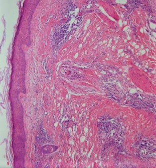 <p>Histopathology of Lichen Planopilaris.</p>