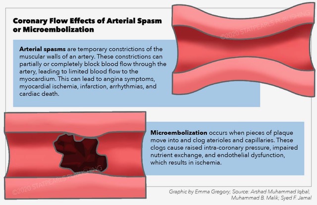 <p>Coronary Flow Effects of Arterial Spasm or Microembolization.</p>