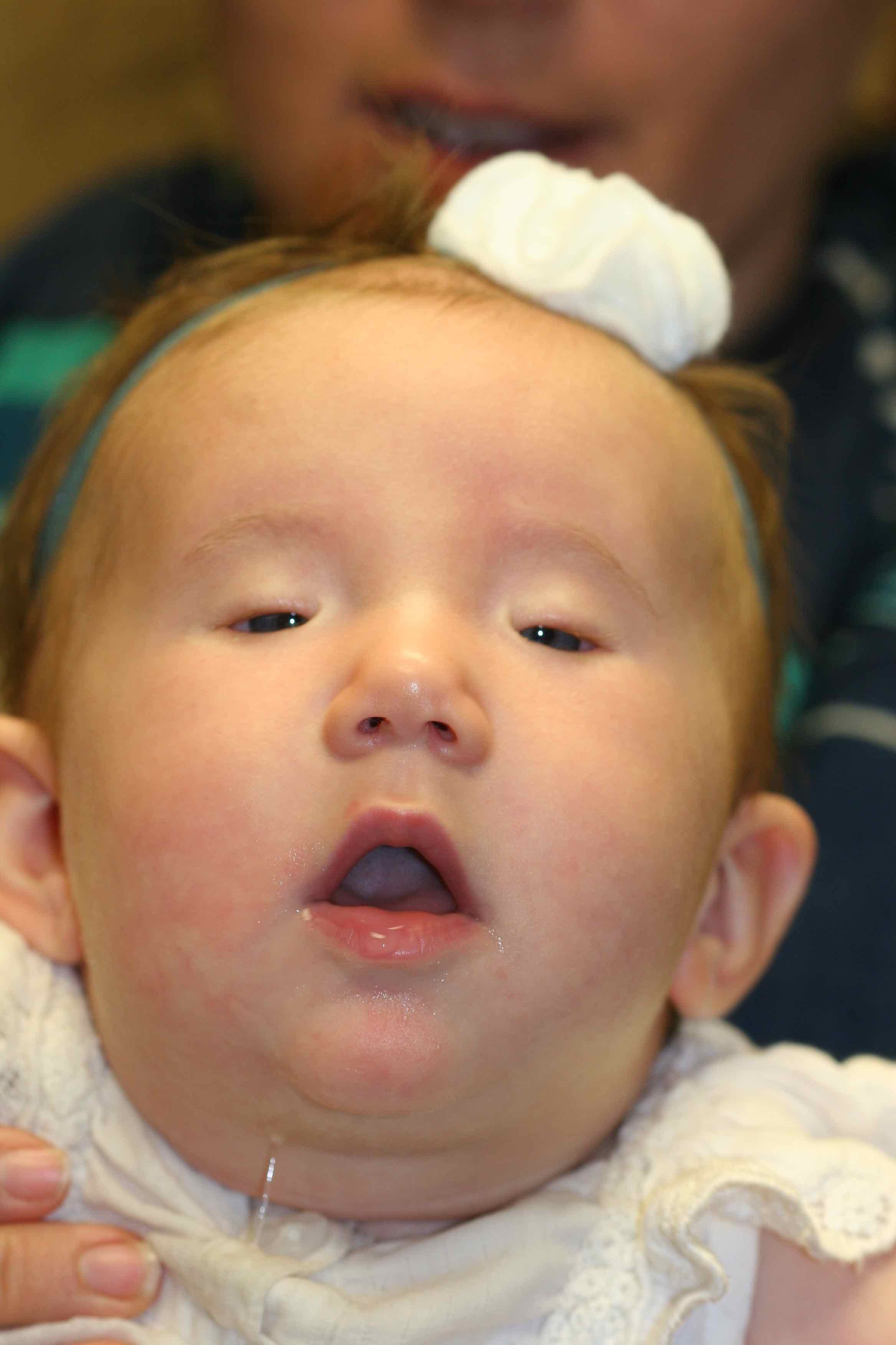 <p>Blepharophimosis Syndrome, Severe Bilateral Ptosis