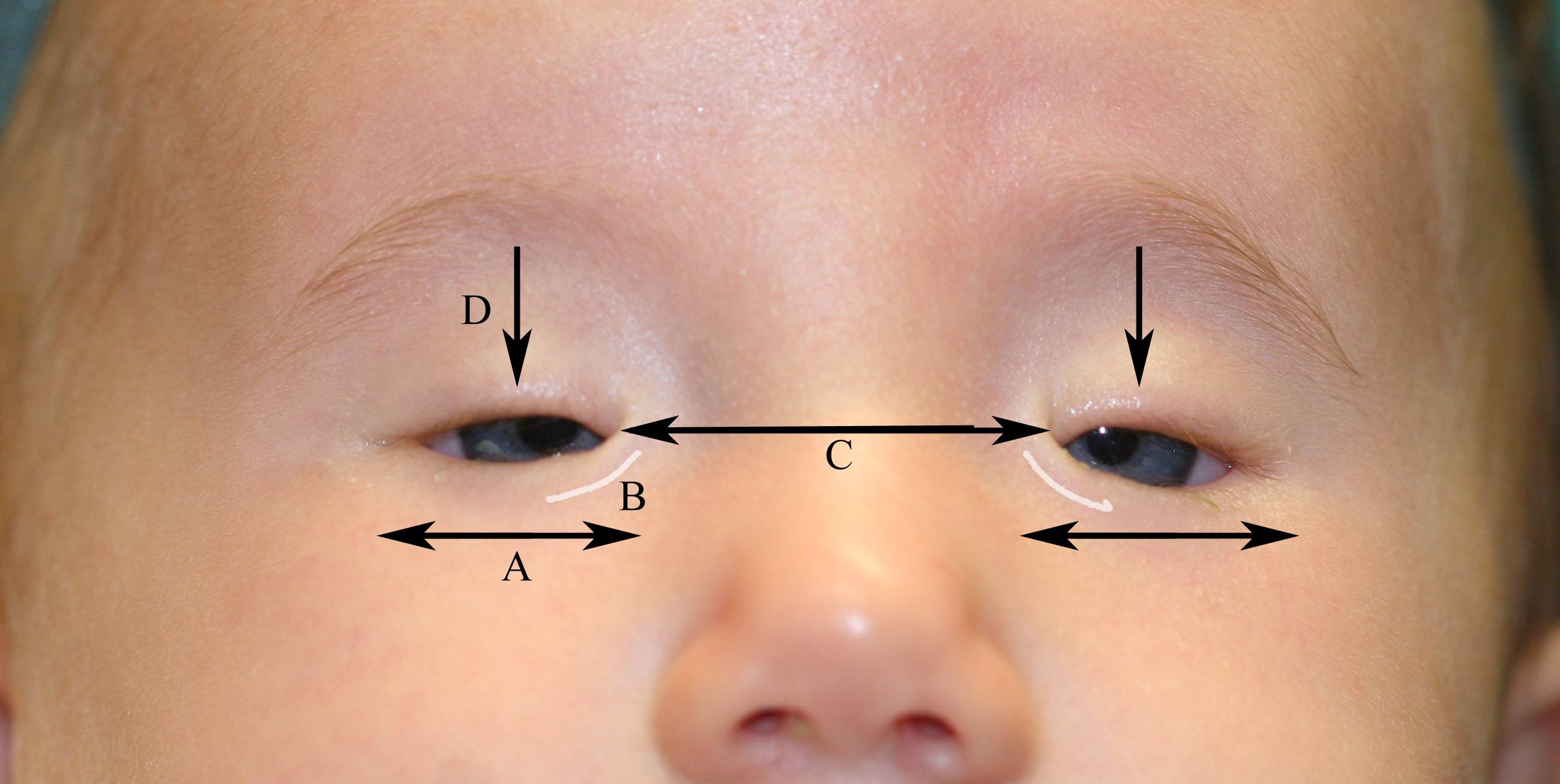<p>Blepharophimosis Syndrome