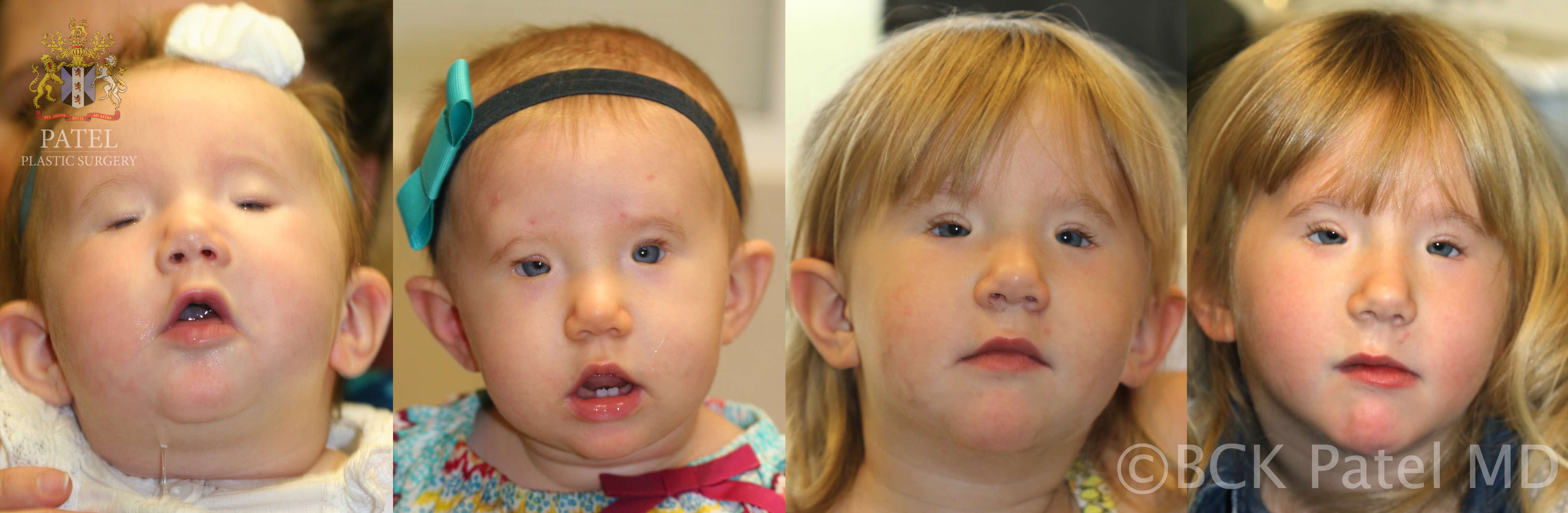 <p>Blepharophimosis Syndrome, Correction of Ptosis