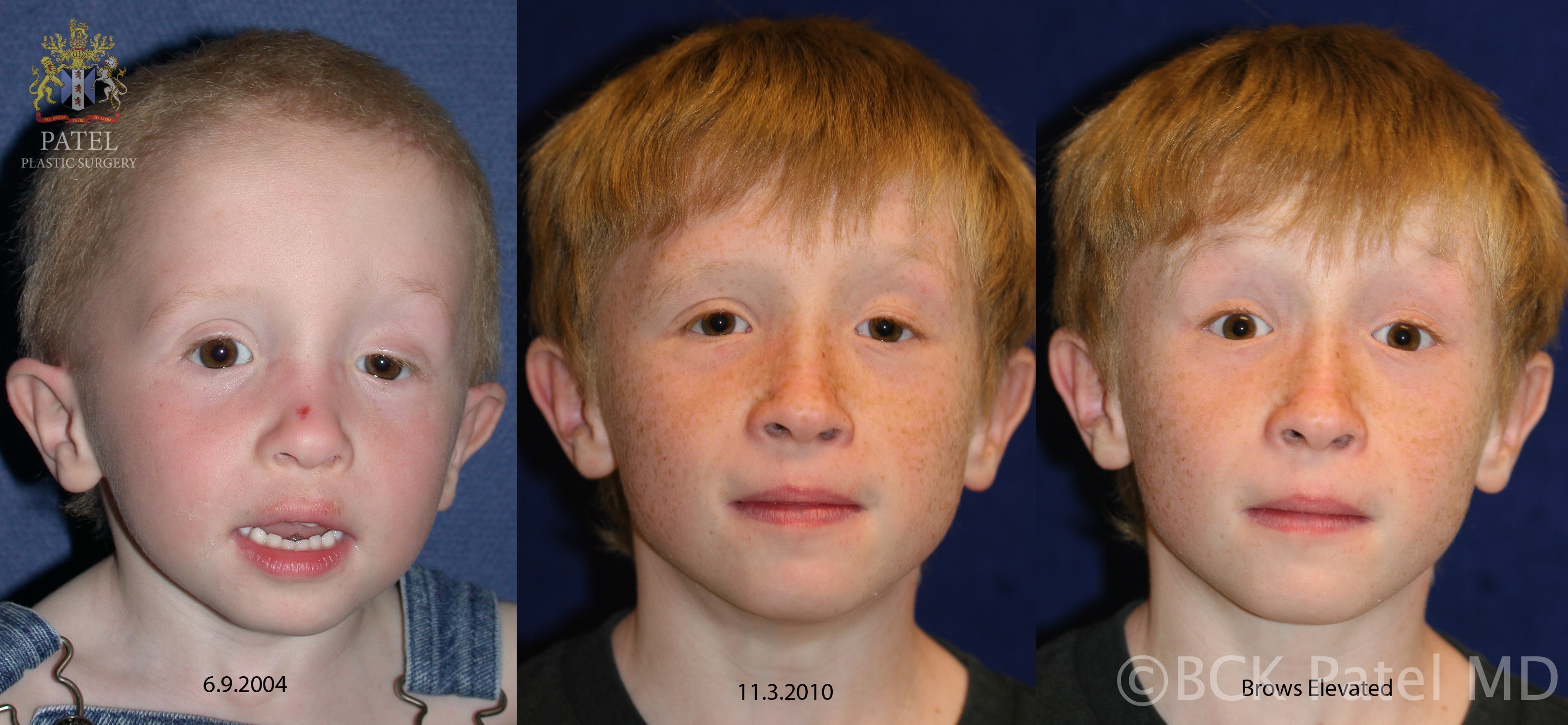 <p>Severe Congenital Ptosis