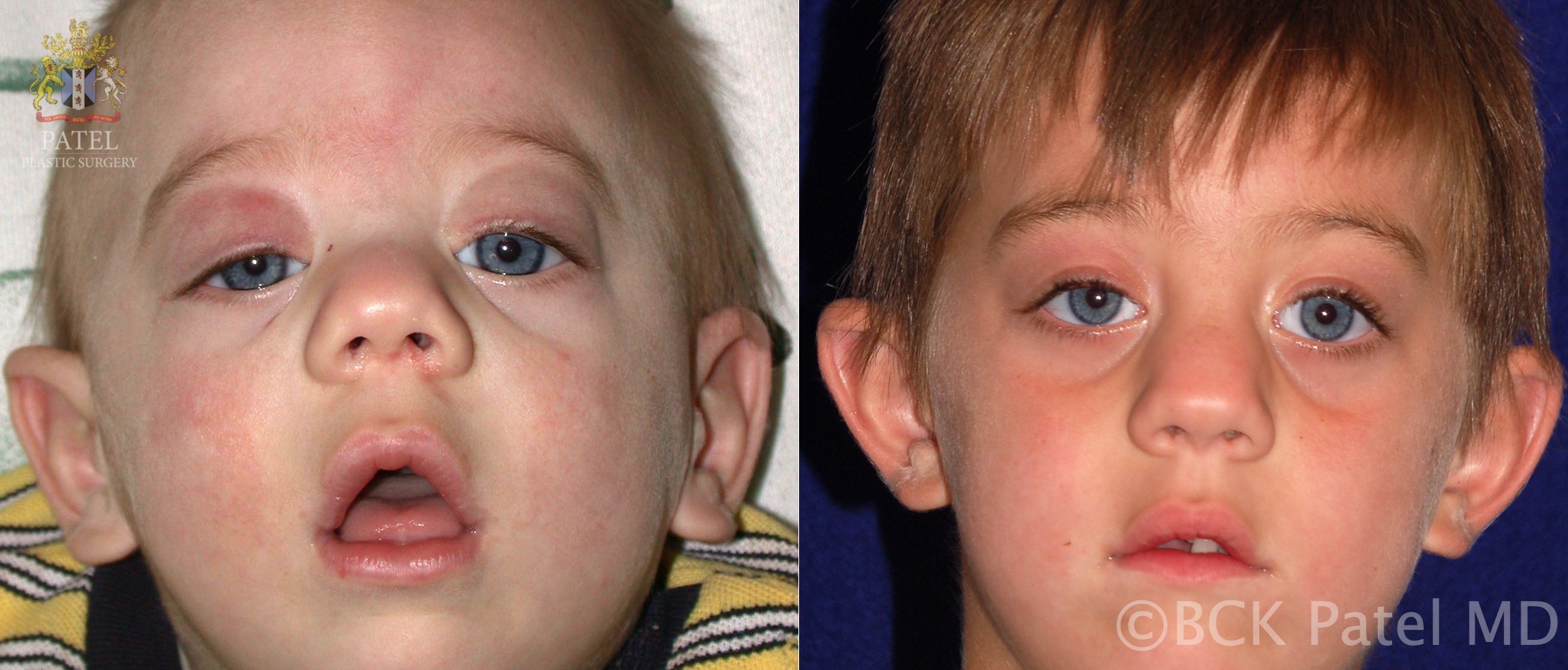 <p>Congenital Ptosis