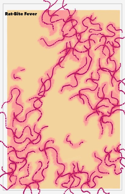 <p>Rat Bite Fever, Histology</p>