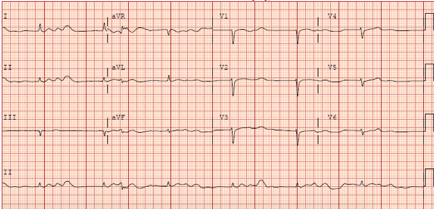 <p>Electrocardiographic Findings in a Patient with BRASH Syndrome