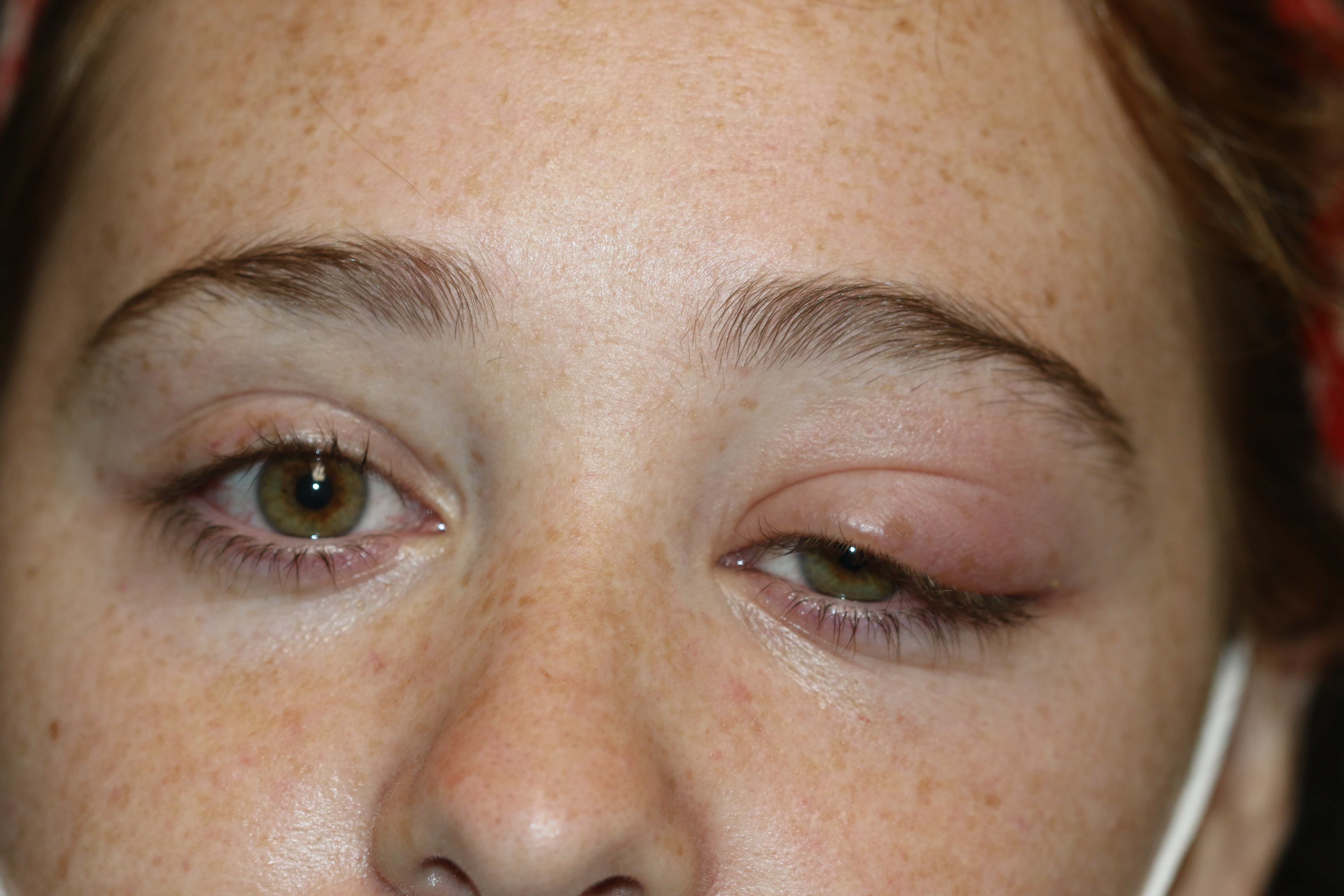 <p>Typical&nbsp;Dacryoadenitis