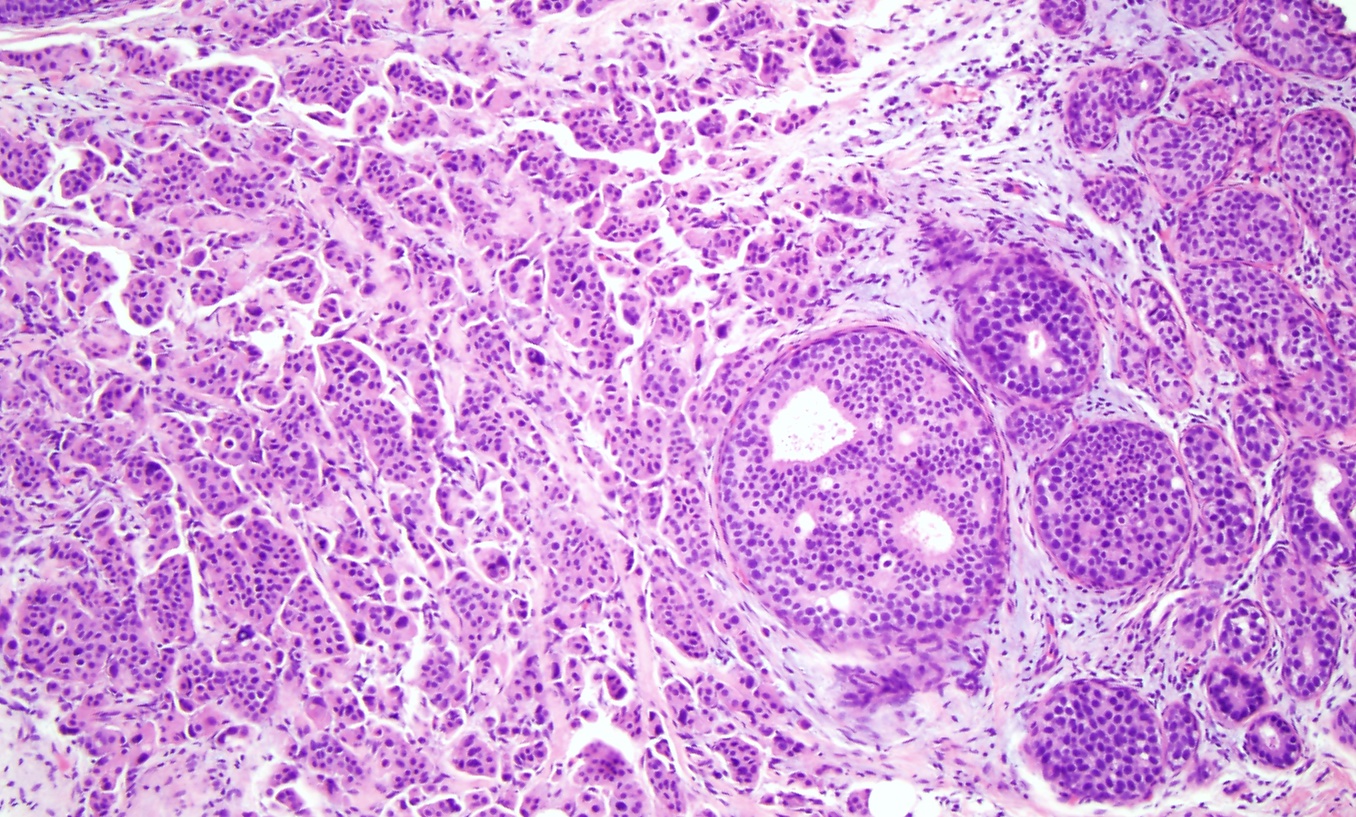 <p>Invasive Ductal Carcinoma