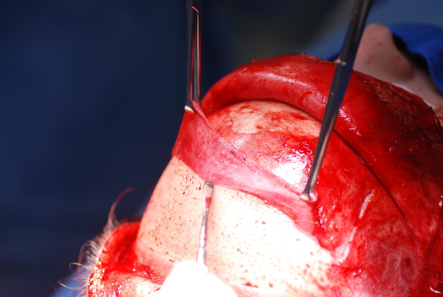 <p>Pericranial Flap Elevation. The pericranial flap can be elevated separately from the forehead flap if necessary.</p>