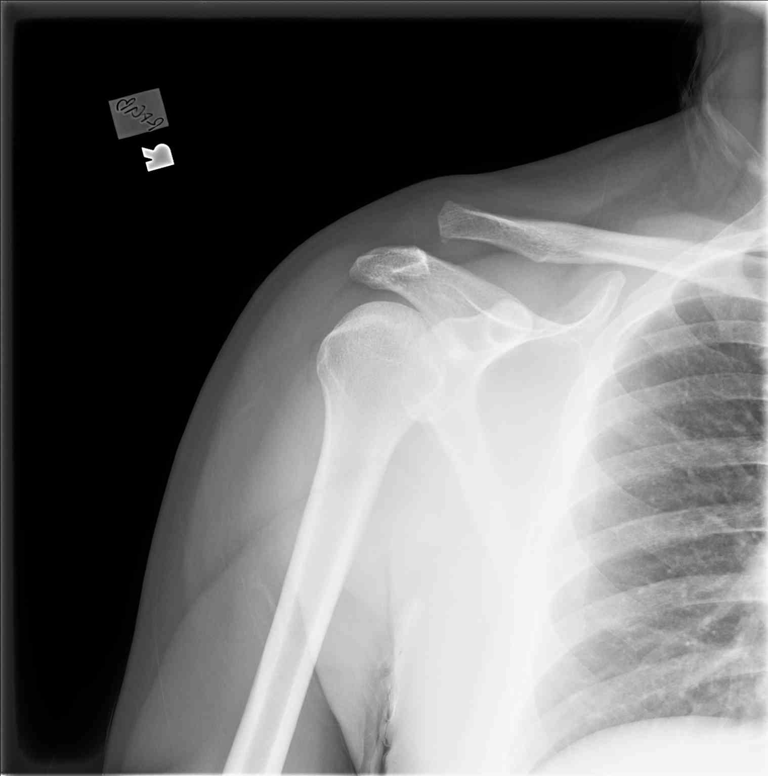 <p>Acromioclavicular Joint Separation With Injury Type III/IV, Shoulder Radiograph