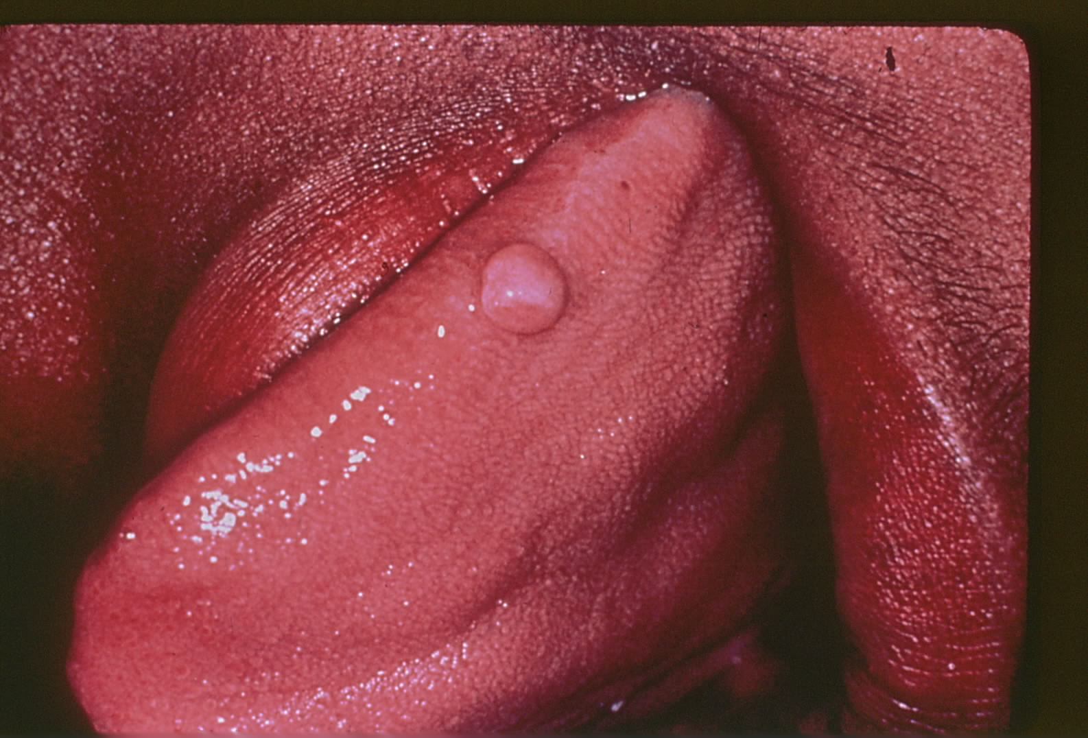 <p>Traumatic Fibroma. This image shows a traumatic fibroma on the tongue's right superior margin.</p>