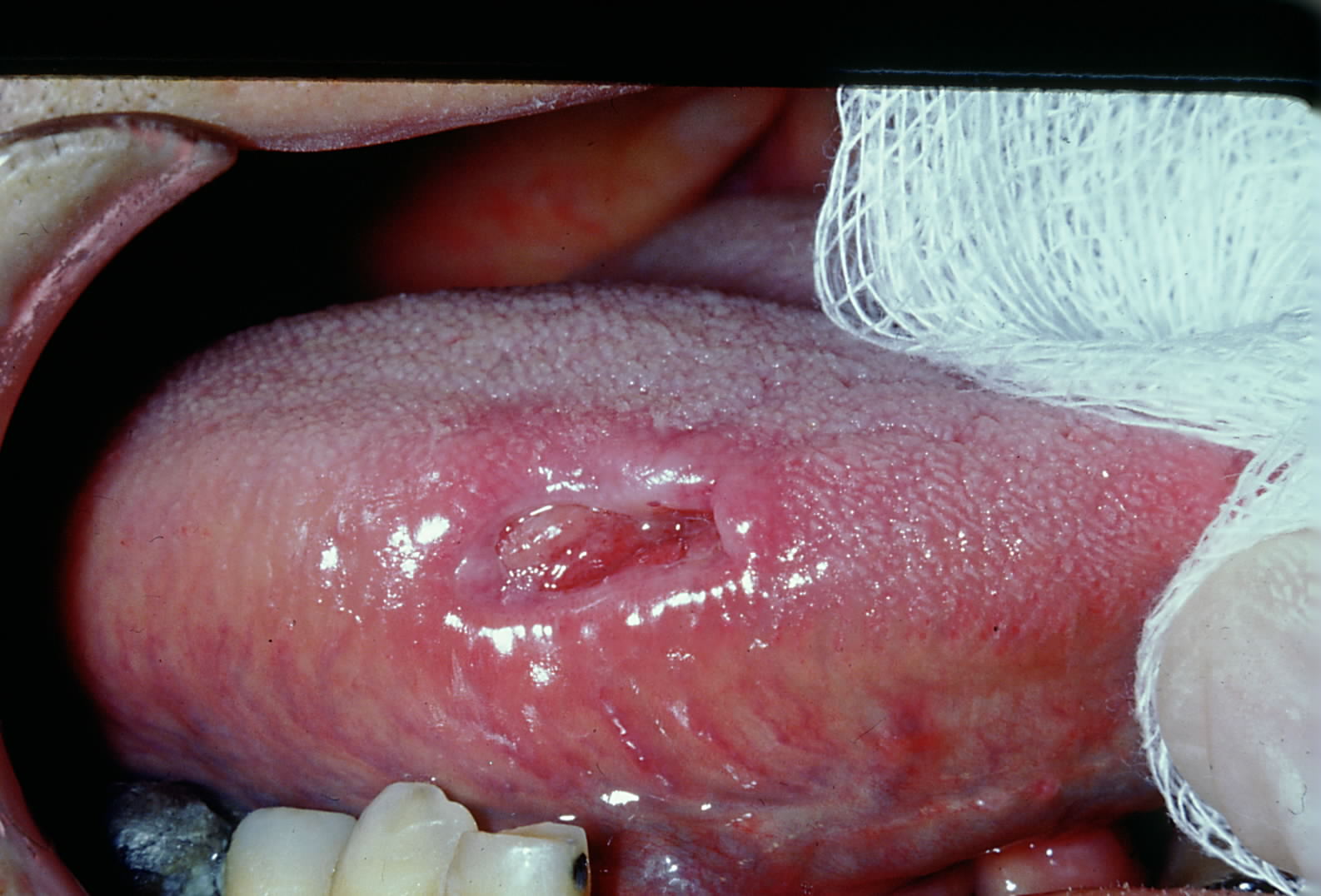 <p>Traumatic Ulcerative Granuloma with Stromal Eosinophilia