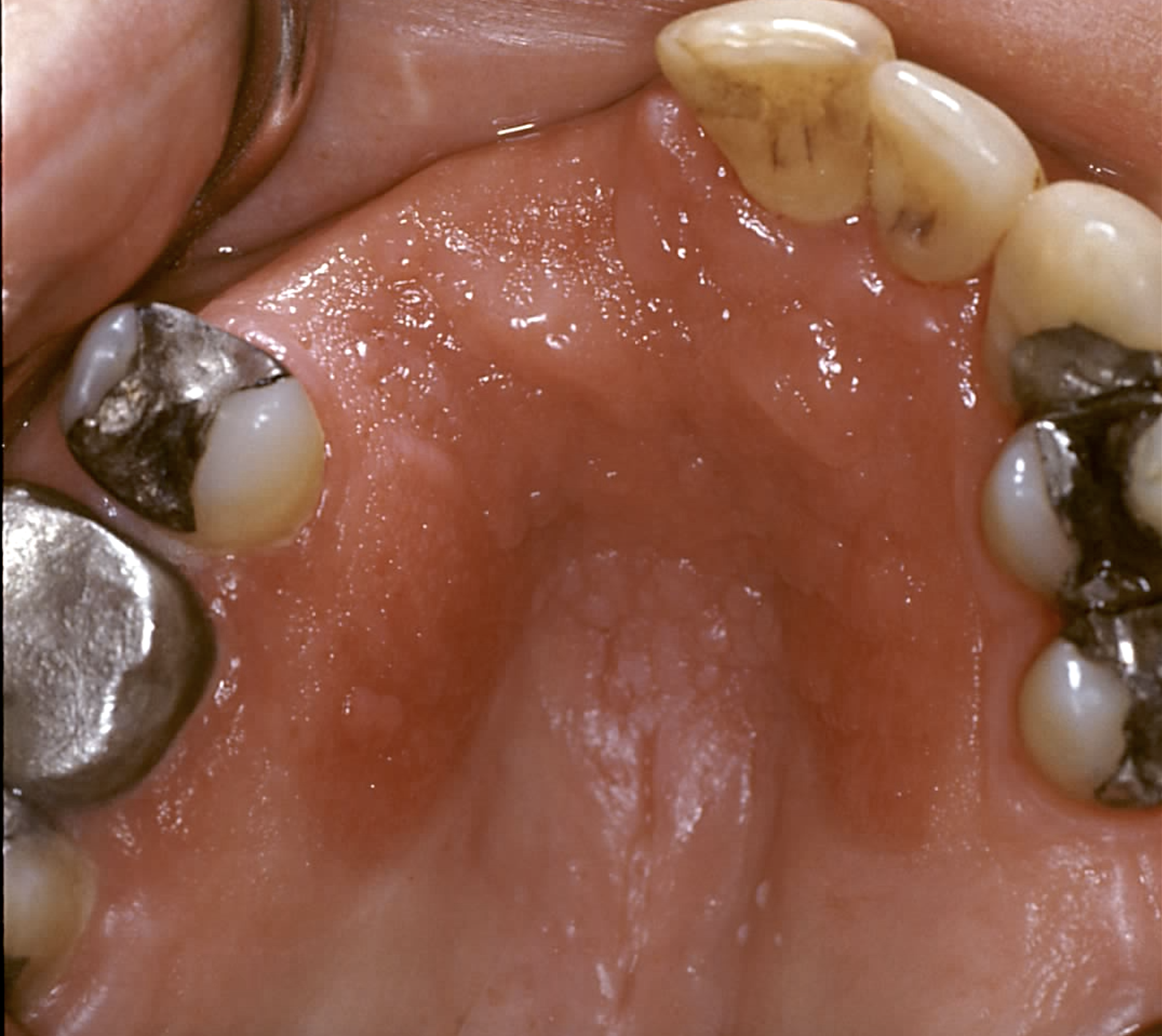 <p>Inflammatory Papillary Hyperplasia