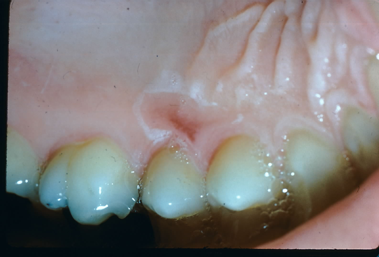<p>Thermal Burn. Note the erythematous ulcer on the palate caused by contact with hot food.</p>
