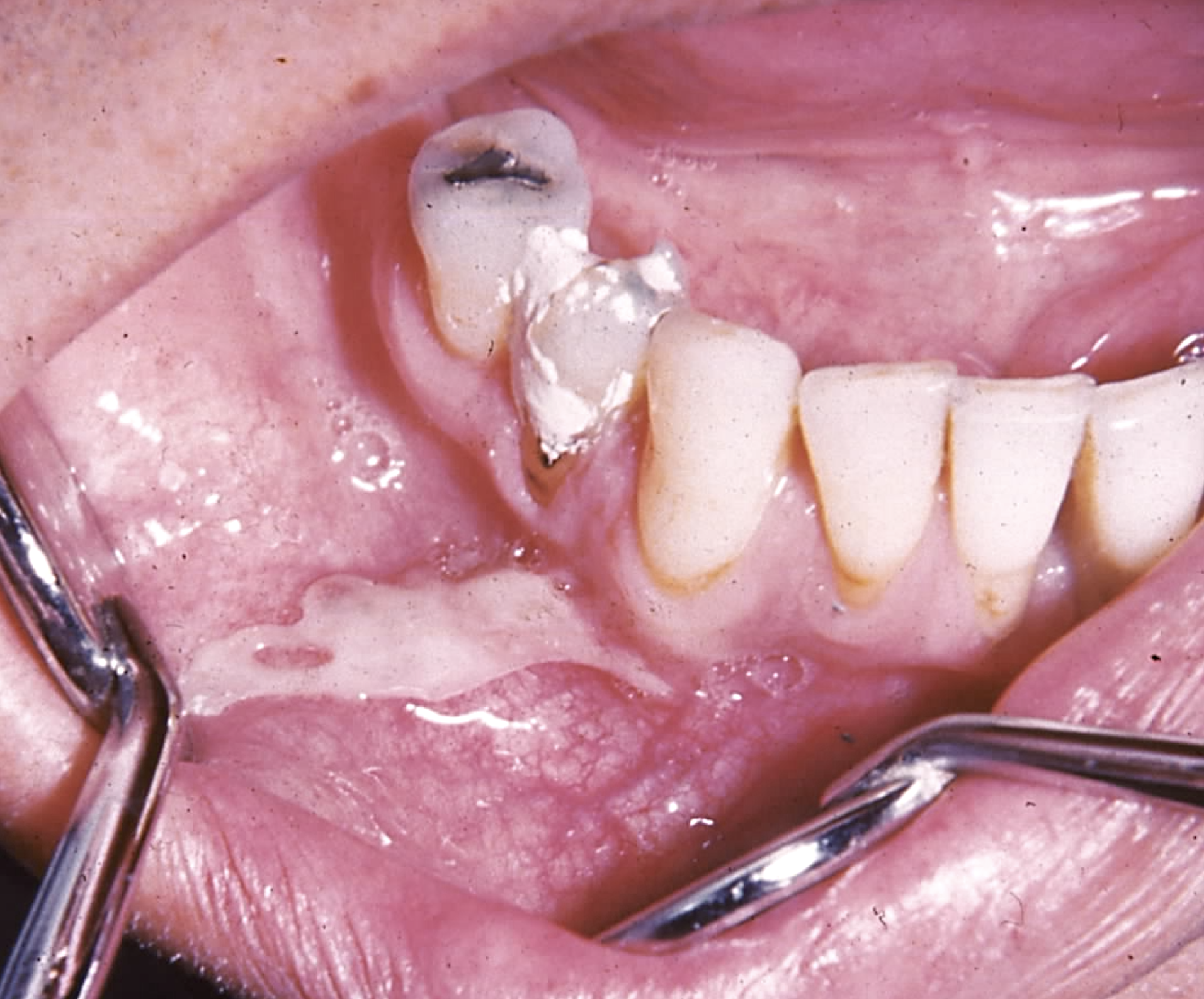 <p>Aspirin-Induced Chemical Burn