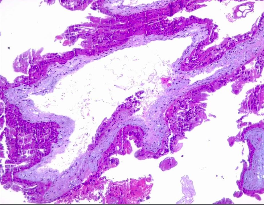 <p>Partial Hydatiform Mole