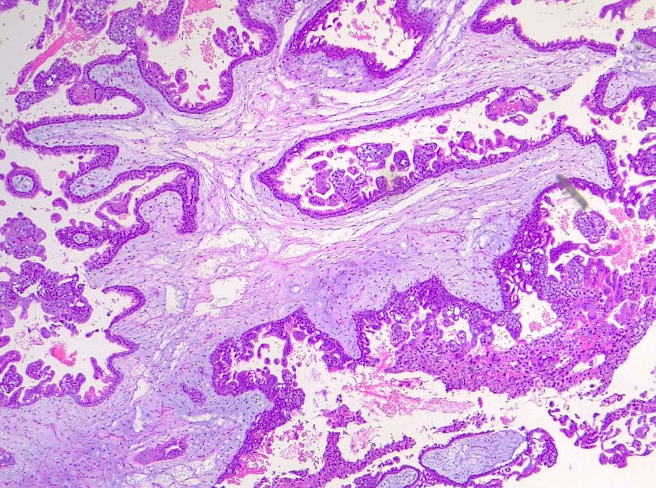 <p>Dysmorphic Villi in Hydatiform Mole
