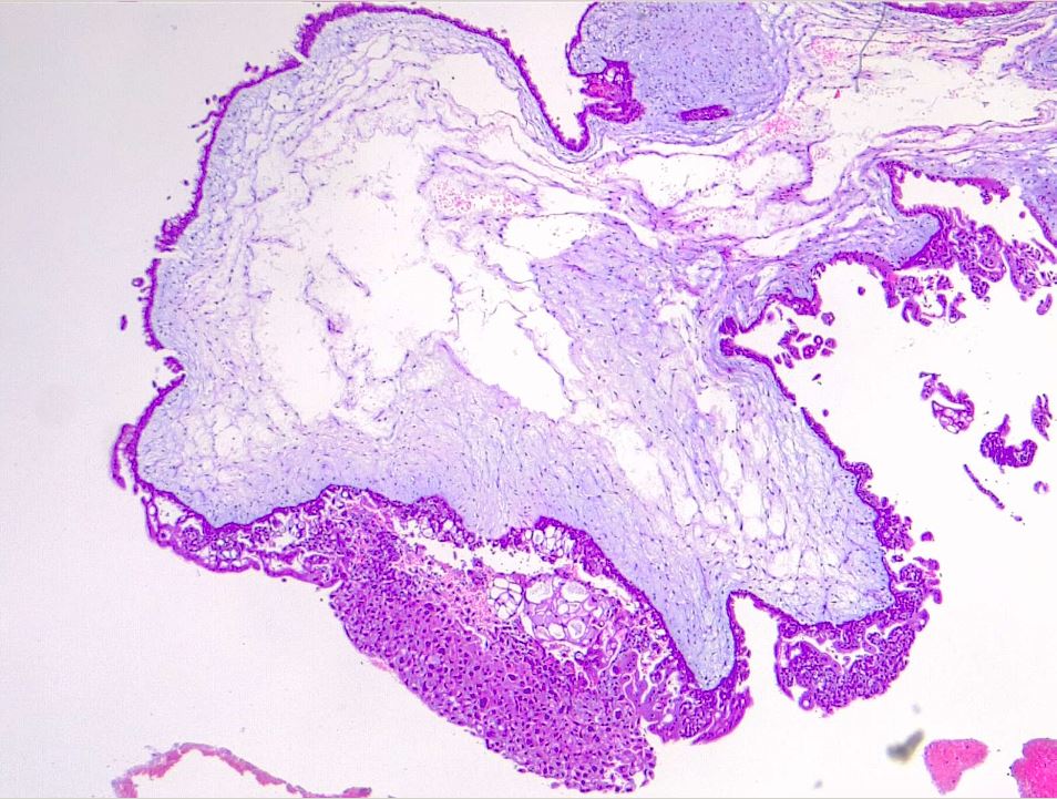 <p>Hydropic Villi and Trophoblastic Proliferation