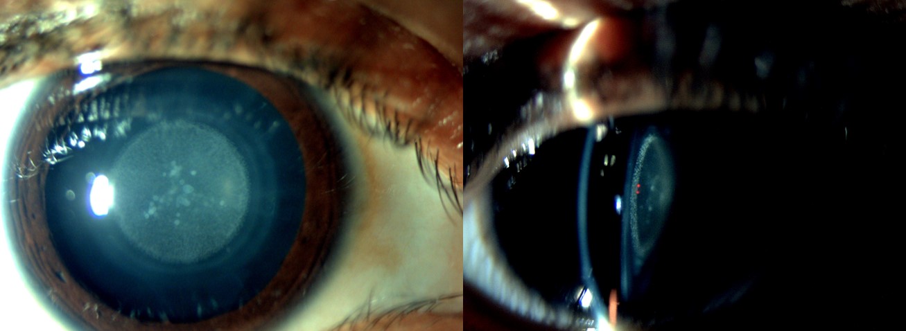 <p>Slit-Lamp Examination of Pediatric Zonular Cataract