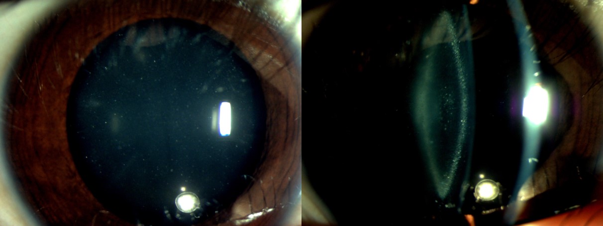 <p>Pediatric Cataract, Zonular Type