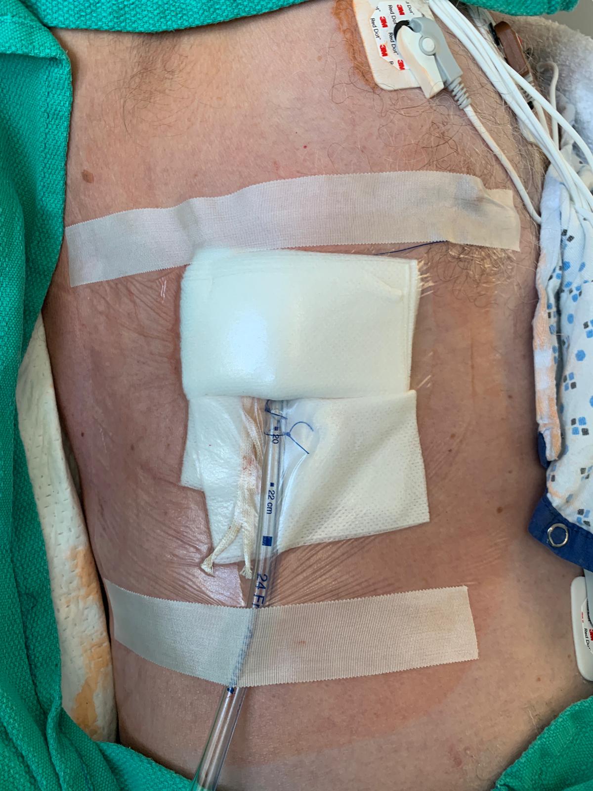 <p>Surgically Placed Chest Tube