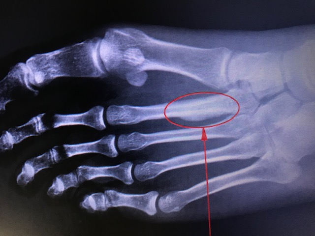 <p>March Fracture of Second Metatarsal