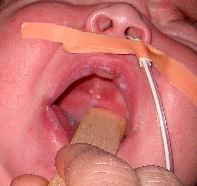 <p>Palatal Cyst of the Newborn.</p>