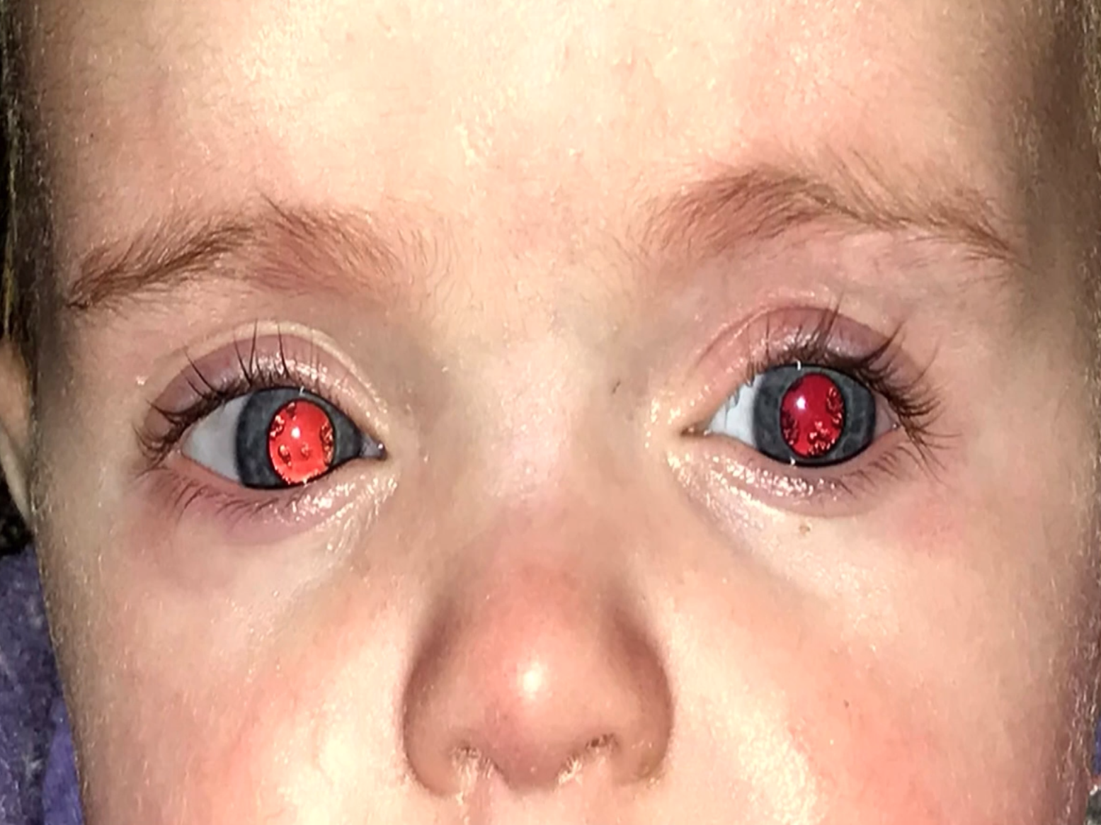 <p>Congenital Cataracts and Abnormal Galactose Metabolism