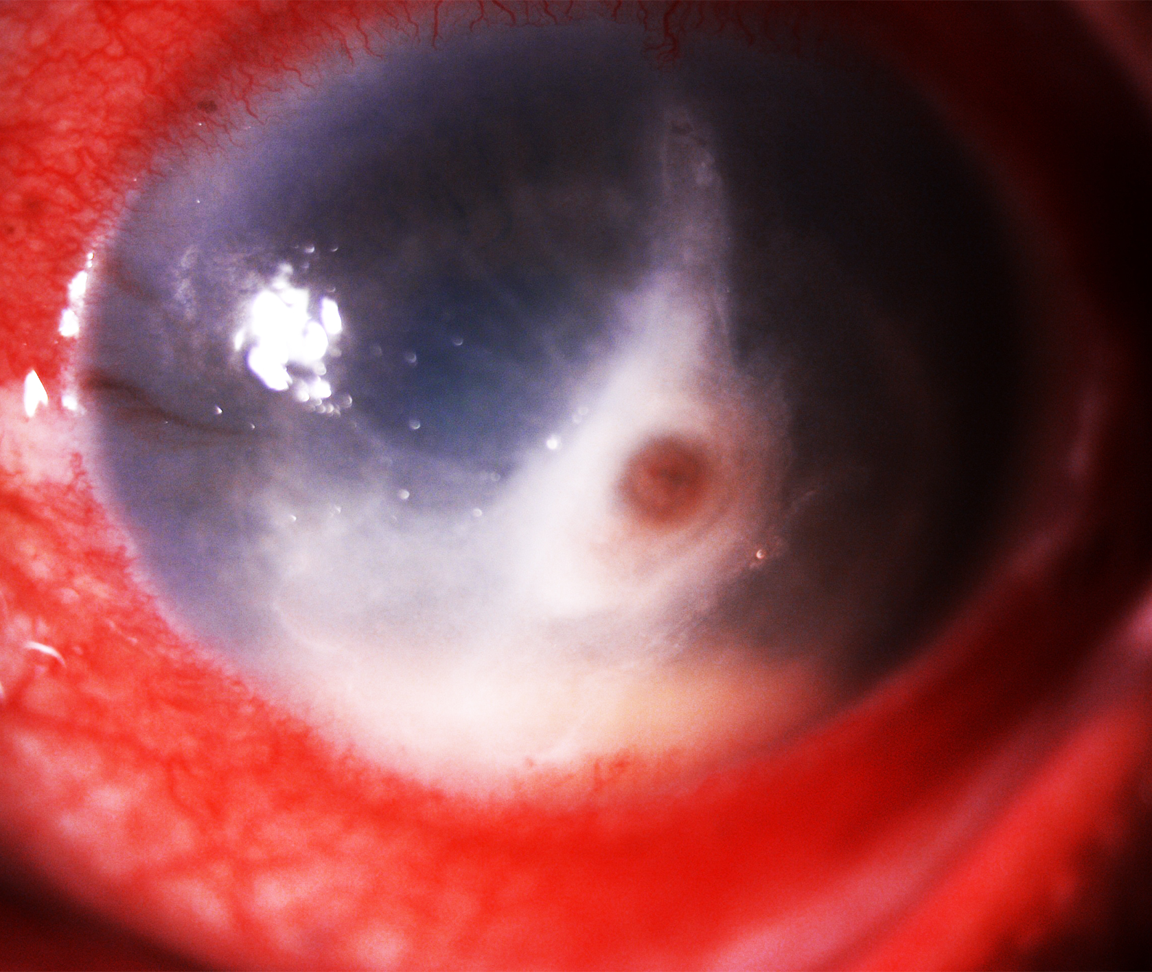 <p><em>Pythium</em> Keratitis with Central Perforation and Limbal Spread