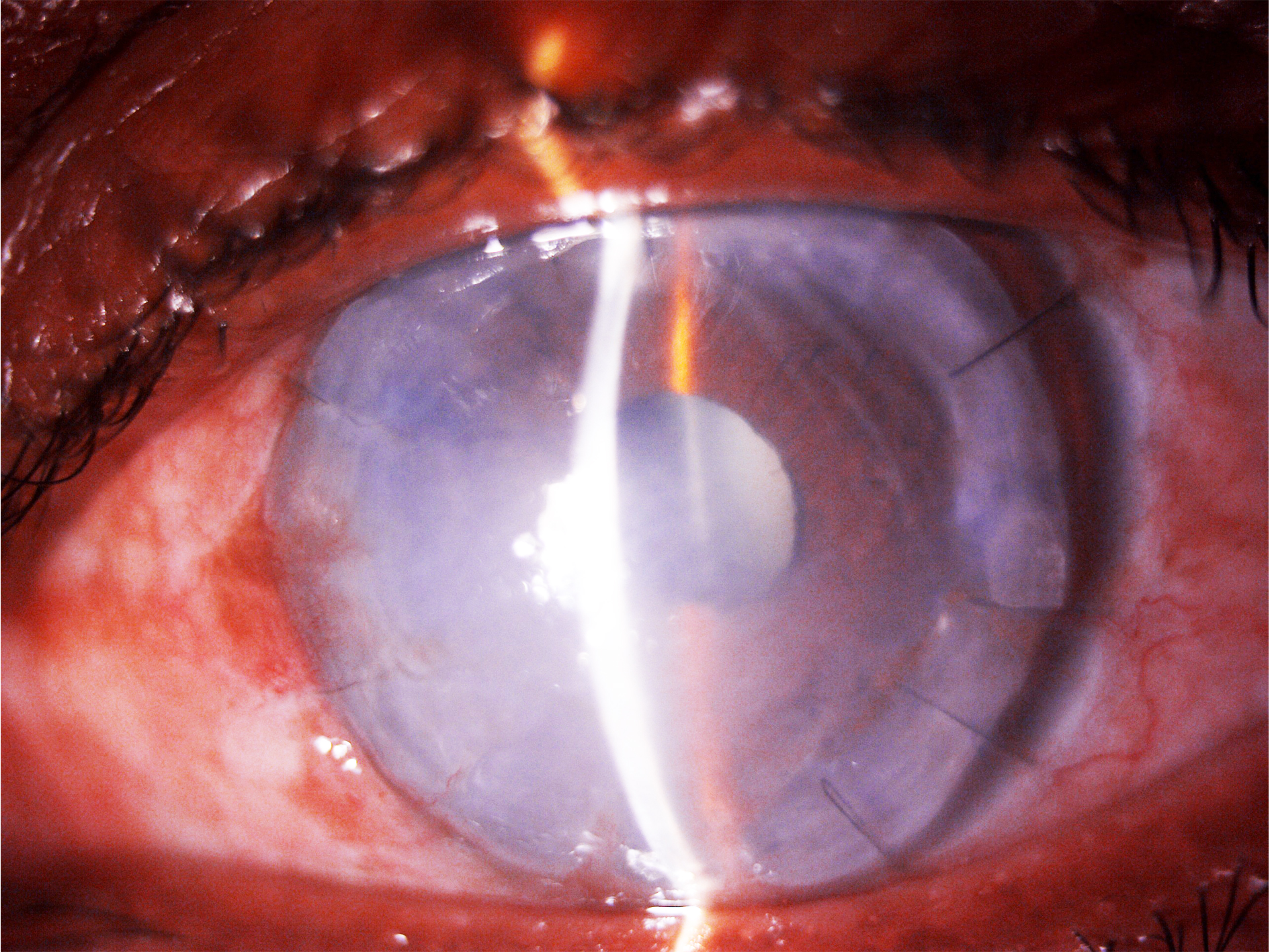<p>Failed Graft Posttherapeutic Keratoplasty in <em>Pythium</em> Keratitis