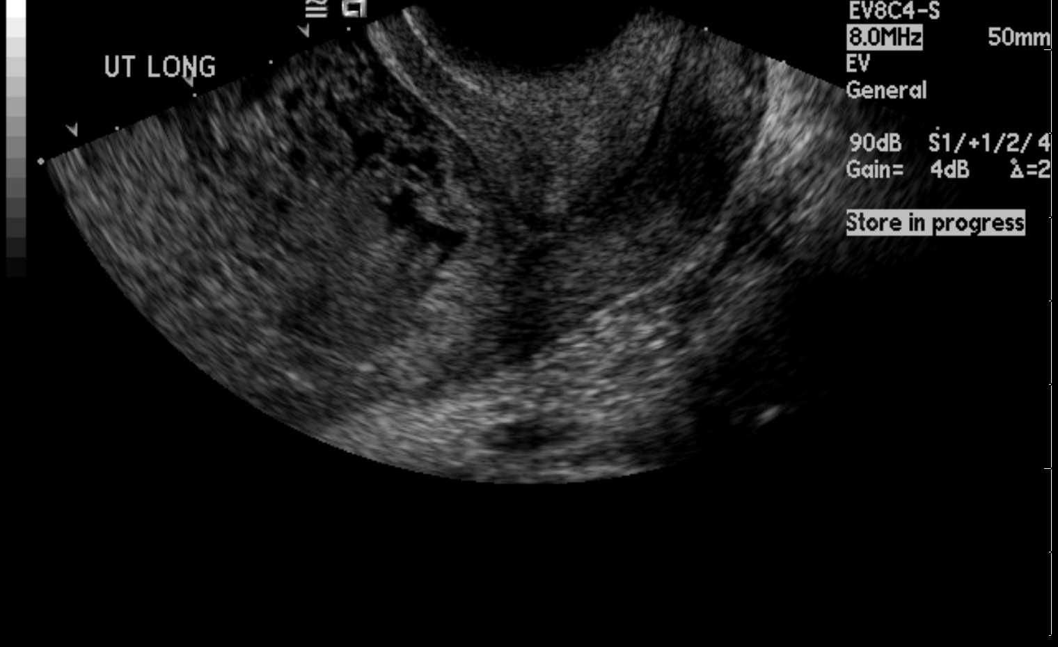 <p>Uterus Ultrasound, Molar Pregnancy. Ultrasound image of a molar pregnancy displaying a "snowstorm-like" appearance.</p>