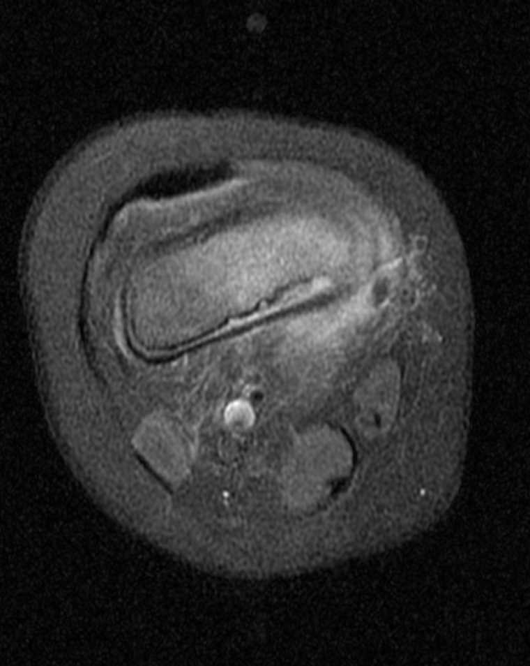 <p>Knee Osteomyelitis on T1-Weighted Postcontrast Magnetic Resonance Imaging