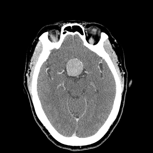 <p>Pituitary Macroadenoma on Head Computed Tomography