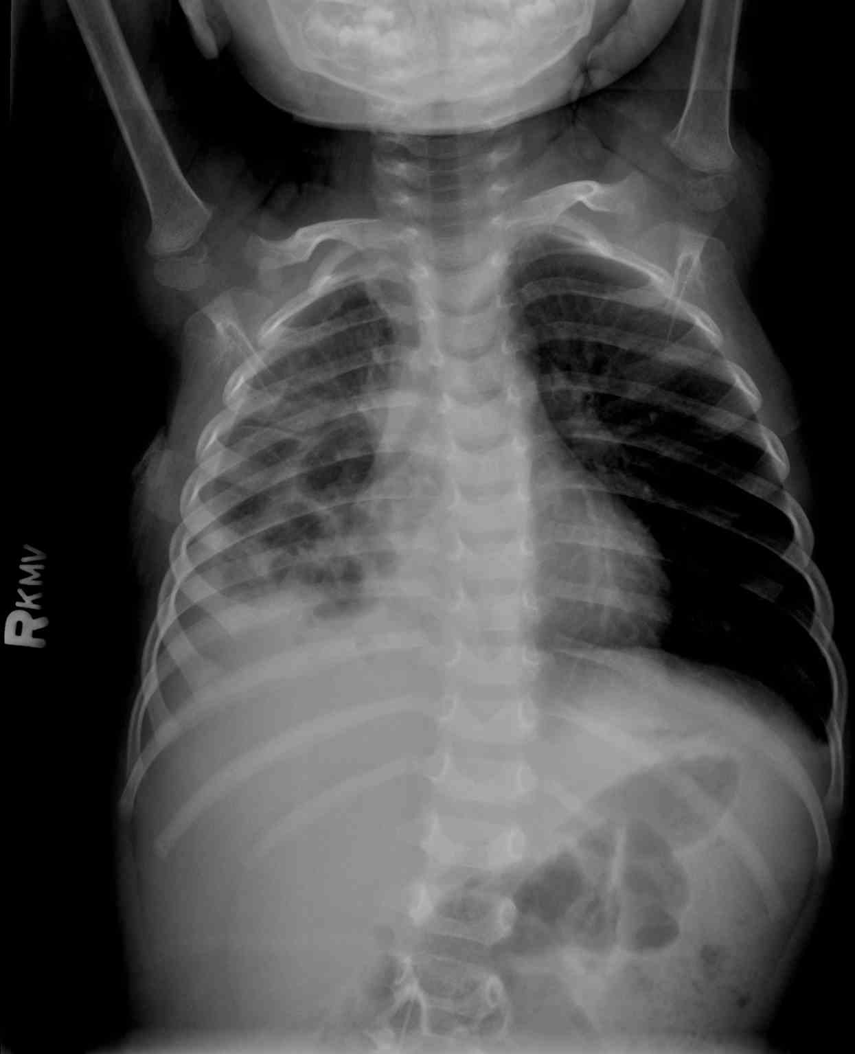 <p>Pneumatoceles on Chest Radiograph. The pneumatoceles seen on this chest radiograph are from pneumonia.</p>