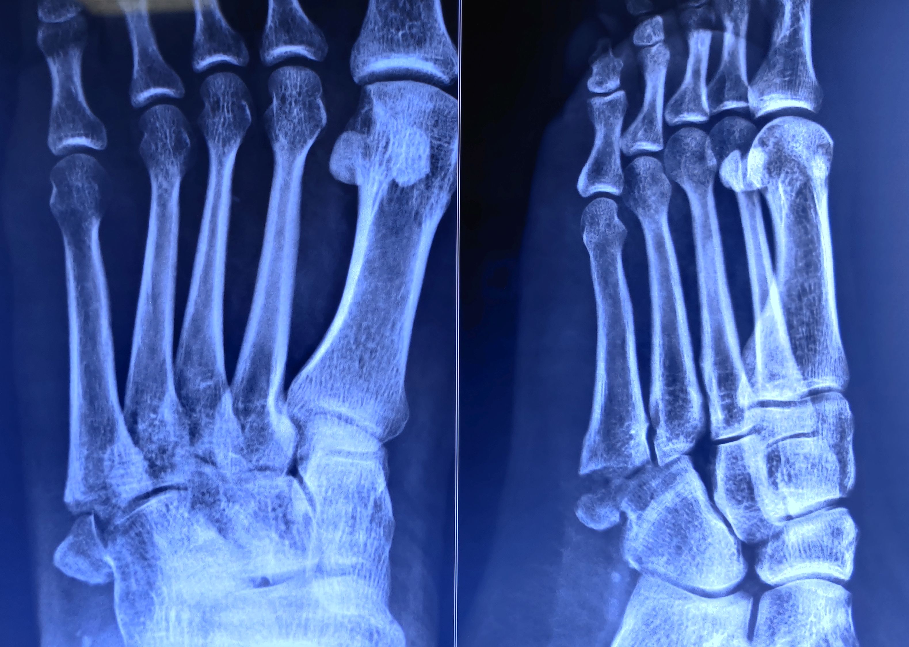 The x-ray of left foot anteroposterior and oblique views showing Jones fracture.