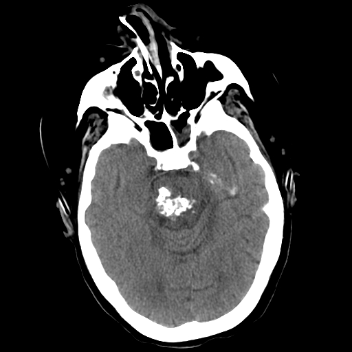 <p>Pons Cavernoma,&nbsp;Head CT