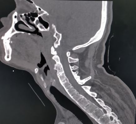Ankylosing spondylitis