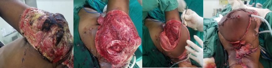 <p>Latissimus Dorsi Myocutaneous Free Flap