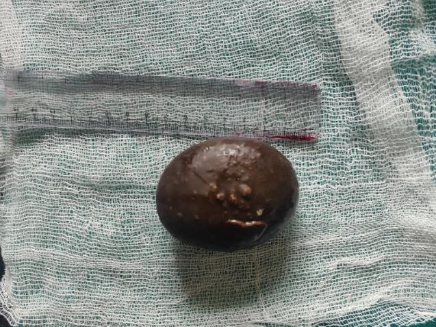 <p>A Bladder Calculus.</p>