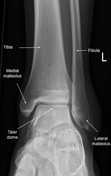 <p>Anatomy of the Ankle Joint. Anteroposterior x-ray of the left ankle.</p>