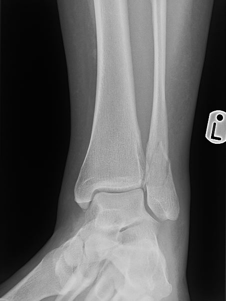 <p>Weber B Fracture. AP x-ray showing left ankle Weber B fracture.</p>