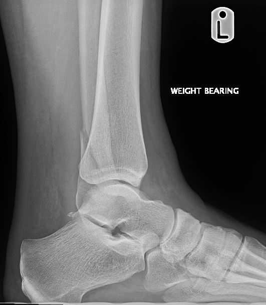 <p>Weber B Fracture of Left Ankle. Lateral x-ray showing Weber B fracture.</p>