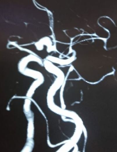 <p>ACOM Aneurysm</p>
