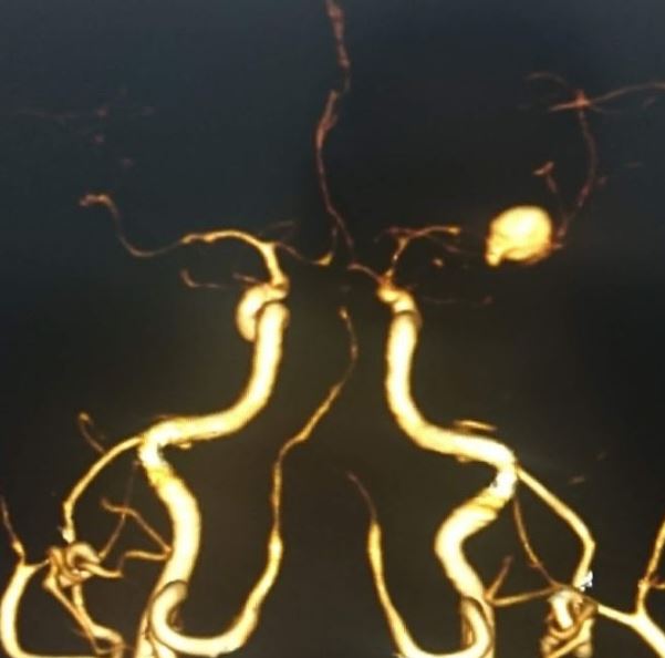 <p>MCA Bifurcation Aneurysm</p>