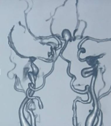 <p>Basilar Tip Aneurysm</p>