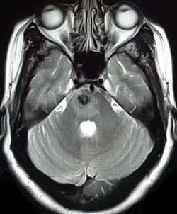 <p>Pontine Cavernoma