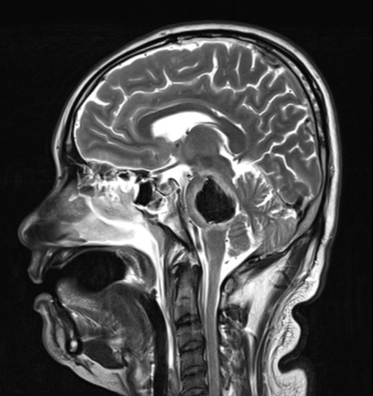 <p>Pontine Cavernoma, Sagittal.&nbsp;MRI image showing a sagittal view of a pontine cerebral cavernous malformation.</p>