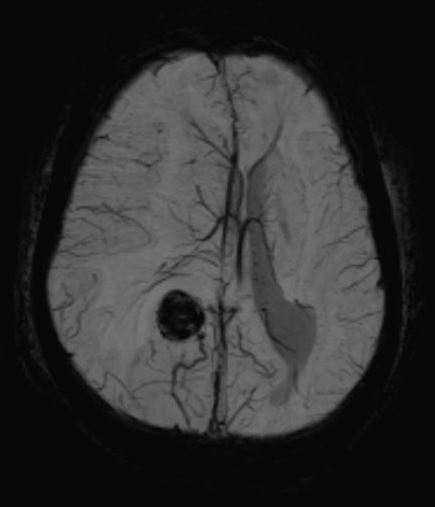 <p>Cortical Cavernoma. MRI image showing a cerebral cavernous malformation.</p>