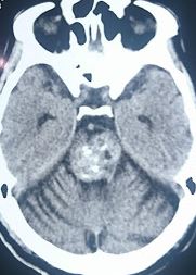 <p>Brainstem Cavernoma. Image demonstrating a cerebral cavernous malformation involving the brainstem.</p>
